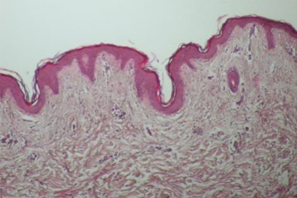 온다 시술전 피부조직