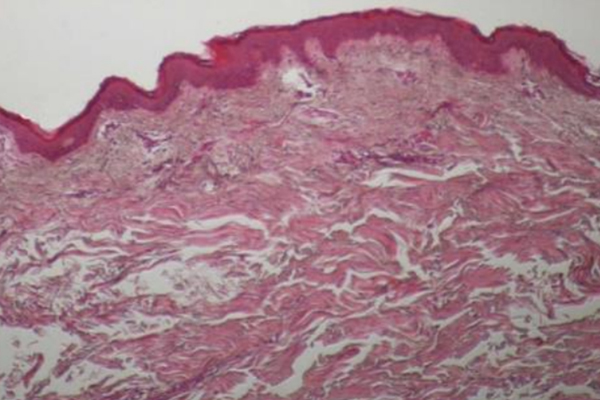 온다 시술 직후 피부조직